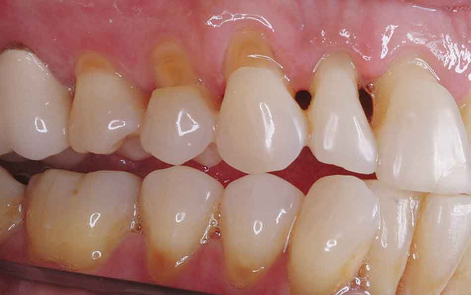 dental abfraction example
