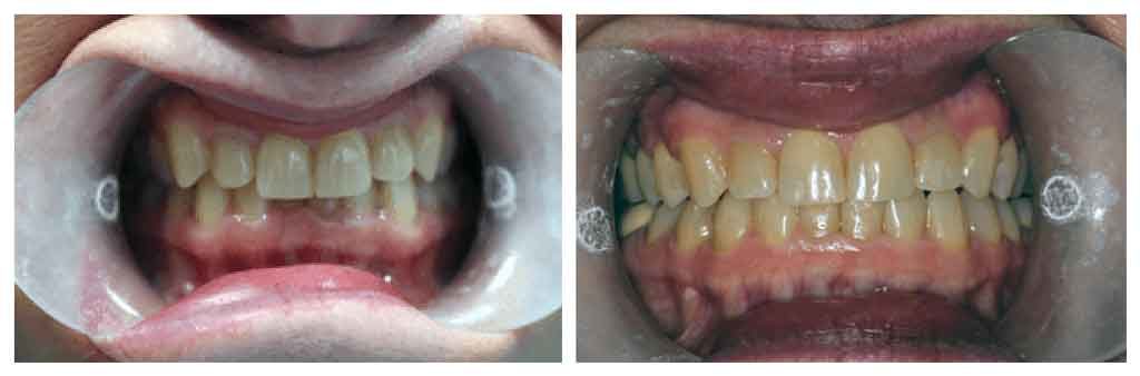 before and after clear correct dental alignment treatment