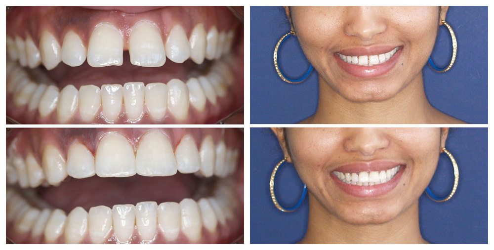 dental bonding patient before and after close up of teeth and smile