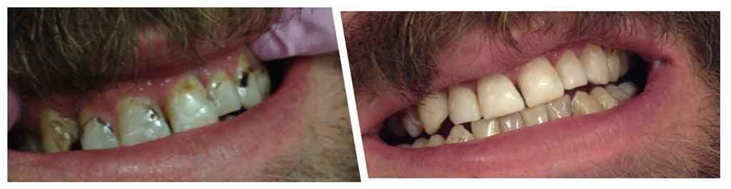 before and after restorative dentistry