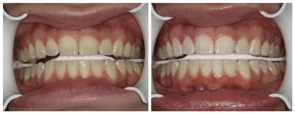 patient's teeth before and after chairside bleaching process