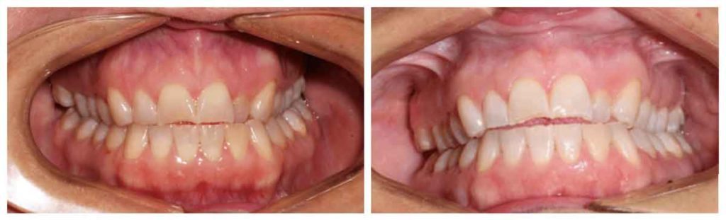 patient's teeth before and after tooth whitening process