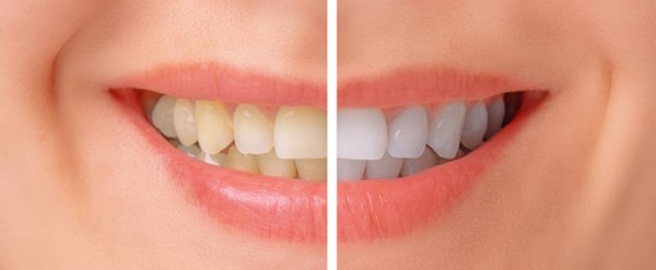 teeth before and after bleaching