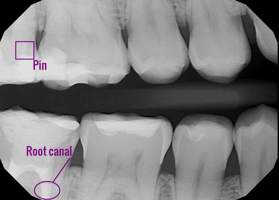 bitewing dental x-ray marked