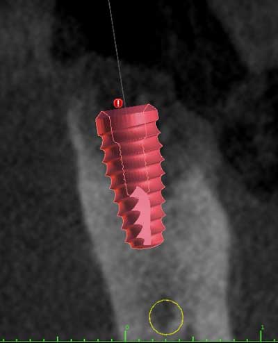 xray of a dental implant case requiring a bone graft