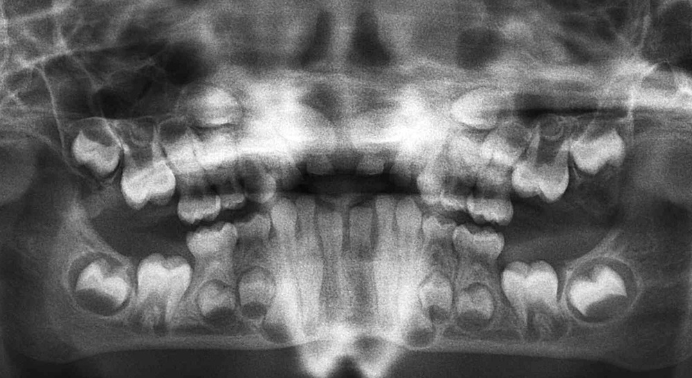PANO xray of a child's teeth