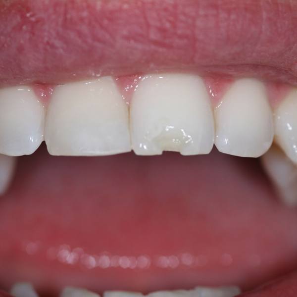 chipped-tooth
