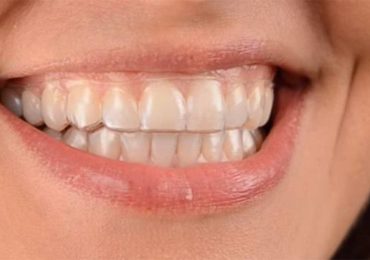woman wearing clear correct invisible aligners