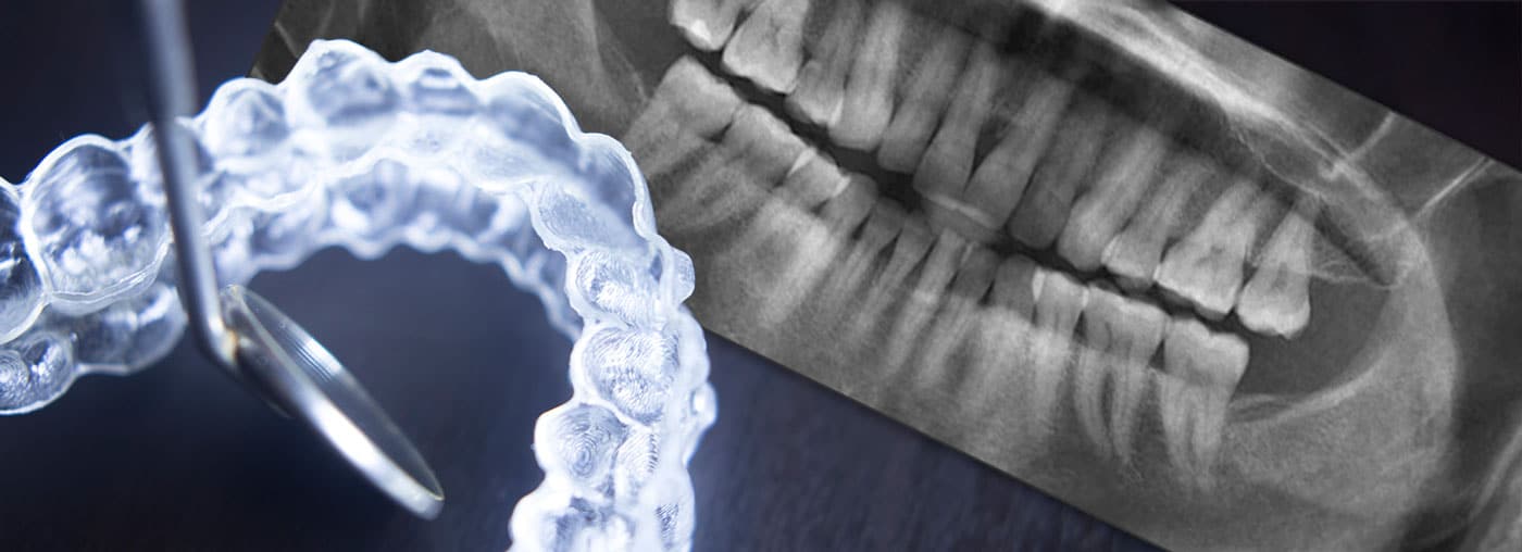 clear dental aligners and dental xrays