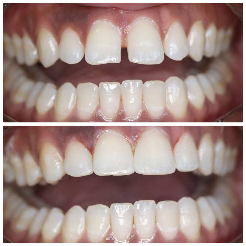 patient's teeth before and after dental bonding to reshape front teeth and reduce gap