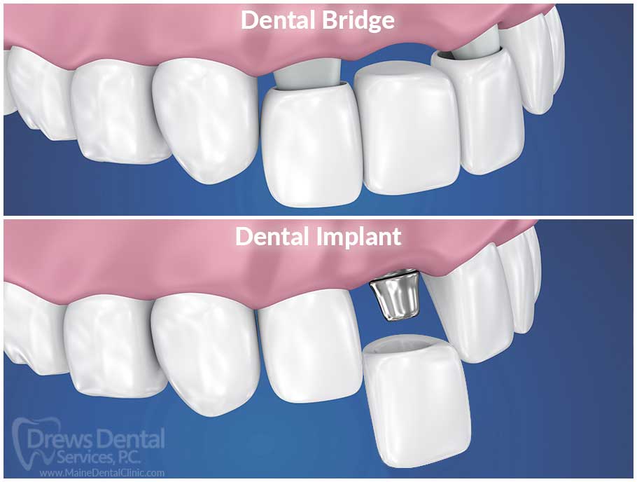 dental bridge vs dental implant diagram