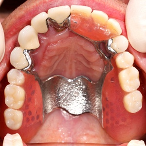 dental partial placed in mouth