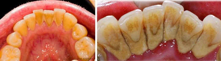 photos of teeth with dental tarter calculus before cleaning