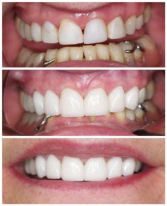 dental veneers patient smile closeup