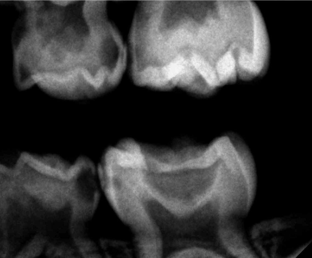 dental xrays showing tooth decay