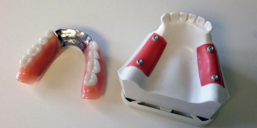 a denture and corresponding implants impression model