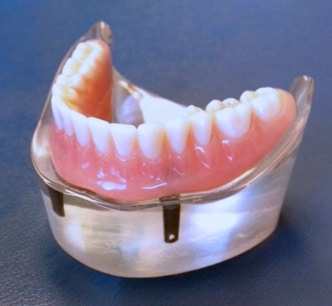 denture seated on implant
