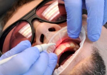 dentist using diode laser