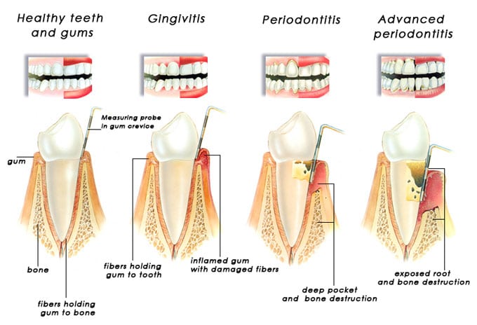 gingivitis periodontitis diagram