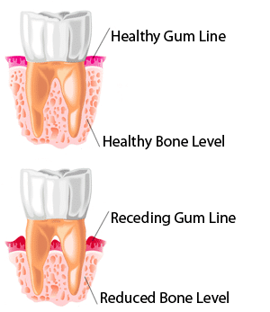 illustration of healthy gums and bone vs receding gums and reduced bone level
