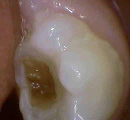 intra oral camera photo of tooth decay