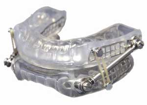 mandibular advancement device