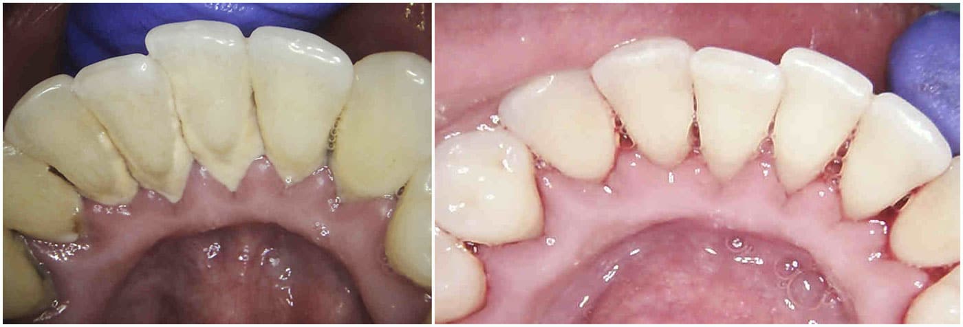 tartar before (left) and after (right) dental cleaning