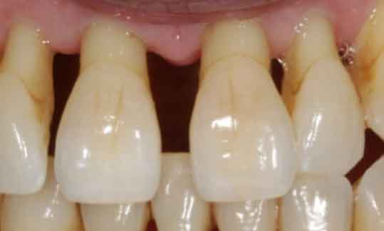teeth with roots exposed