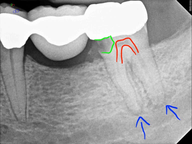 xray of a decay under a dental bridge