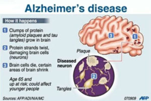 alzheimers disease diagram how it happens