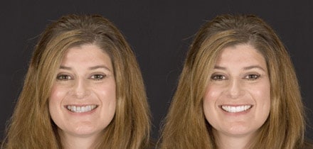 one of the before and after smile makeover images from the study side by side