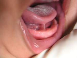 example of a baby with tongue-tie