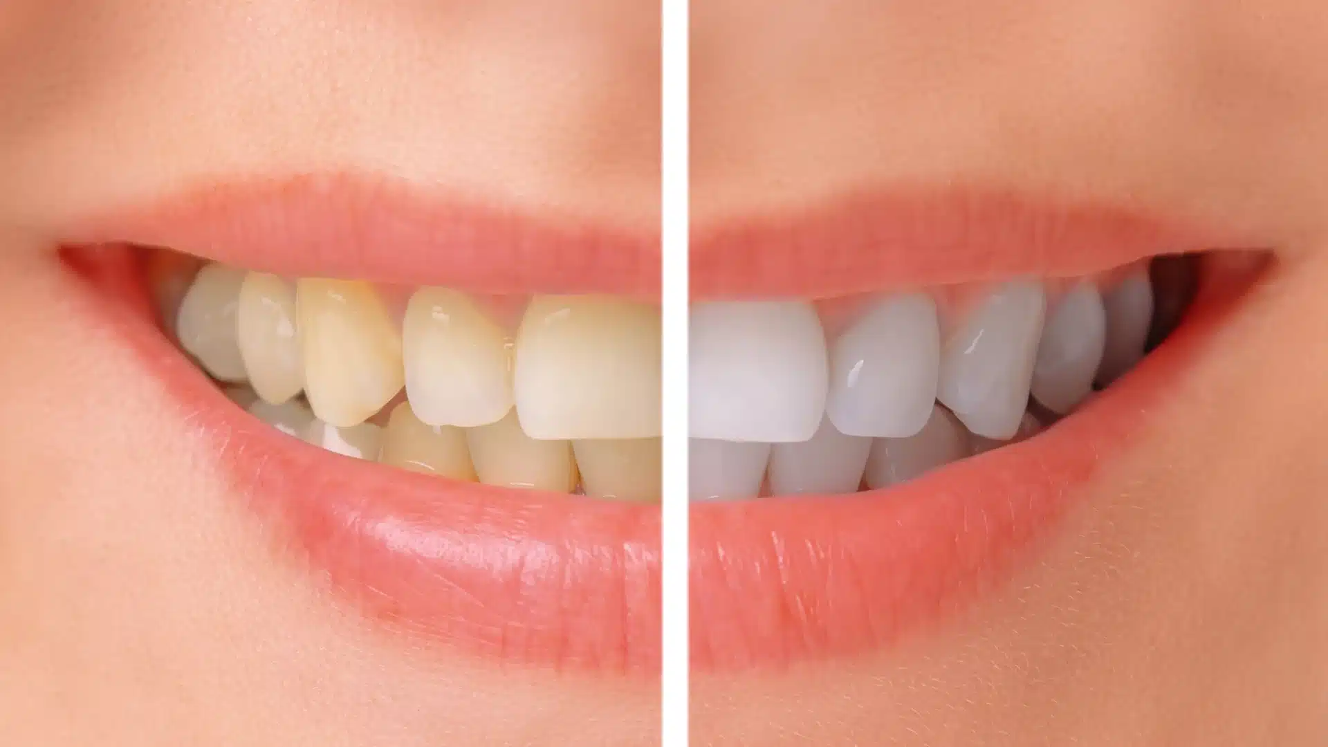 teeth before and after chairside bleaching
