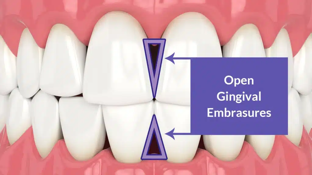 Illustration of black triangles between teeth