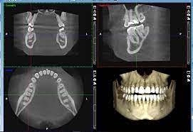 3D imagery sample from Cone Beam Computed Technology also known as CBCT imaging