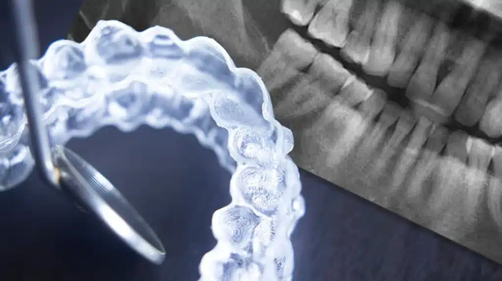 clear dental aligners and dental xrays