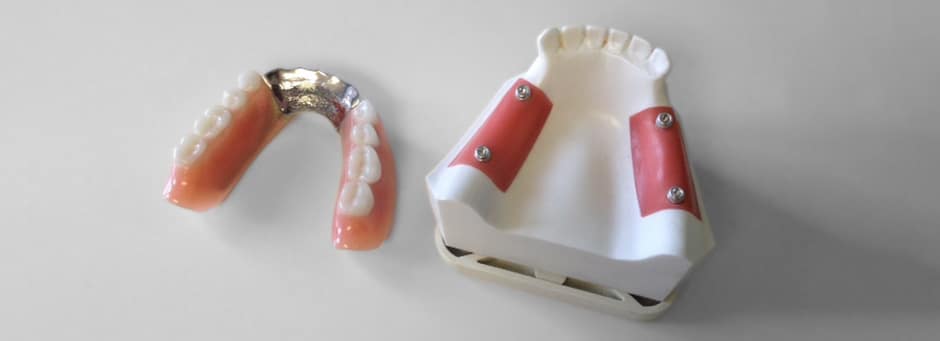 a denture and corresponding implants impression model