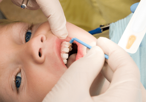 Dental hygienist applies fluoride varnish to a young child's teeth during a pediatric treatment.