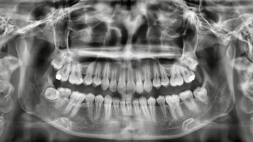 full dental xray film