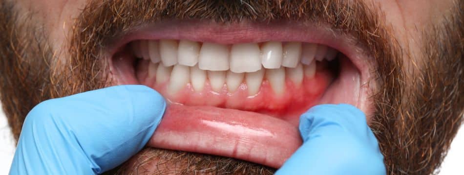 Close-up of inflamed gums during gum disease exam