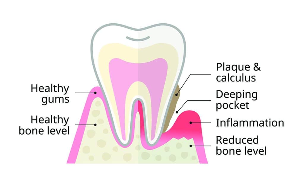 Cross-section dental illustration comparing healthy gums and bone level with gum disease featuring plaque, inflammation, deeper gum pocket, and bone loss.