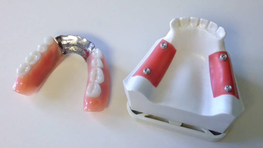 denture and corresponding implants impression model