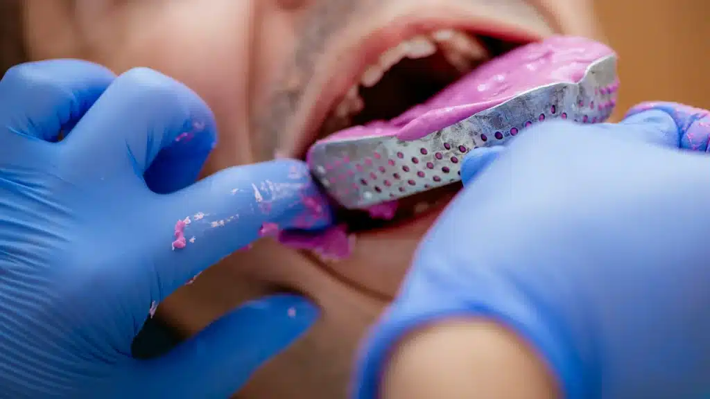 overly messy dental impression