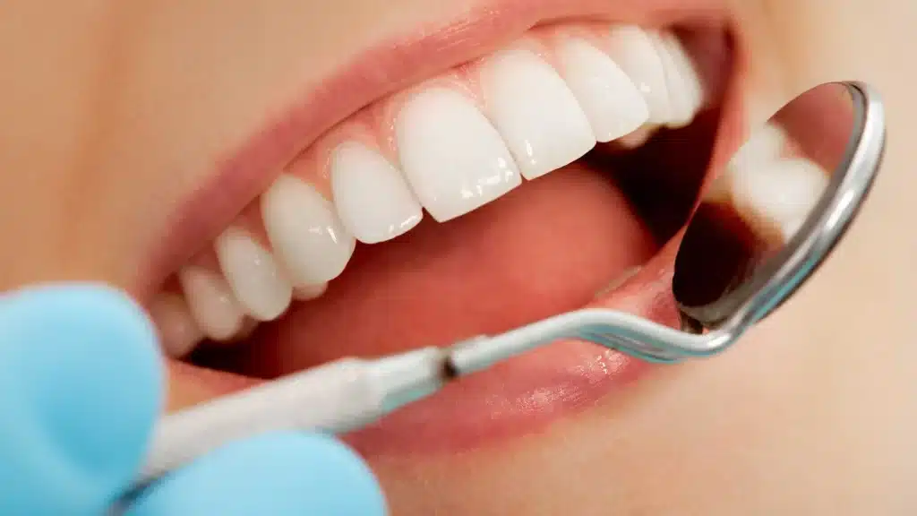close-up of dental veneers