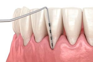 Dental illustration showing a periodontal probe inserted between the tooth and gum to measure pocket depth in millimeters.