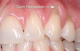 photo of person's teeth with an arrow pointing to the receding gumline
