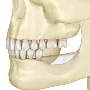 Medical illustration of lower jawbone showing bone loss after missing molars, highlighting the effects of tooth extraction on the alveolar ridge.